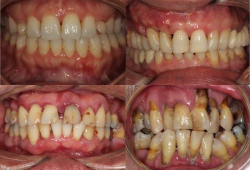 Non-surgical Management of Periodontal Disease